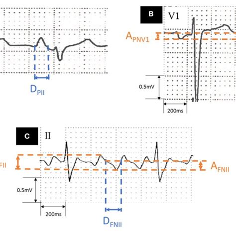 | Measurement of ECG parameters. (A) Lead II during sinus rhythm. (B ...