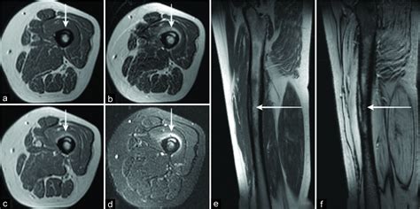 Vastus Medialis Oblique Mri