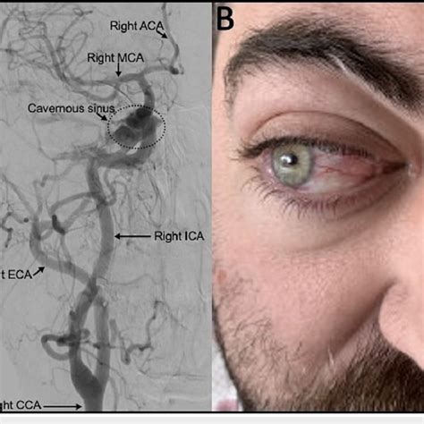 Angiography And Post Operative External Ocular Examination A Dsa