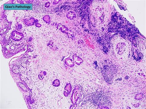 Qiaos Pathology Adenocarcinoma Of The Urinary Bladder Flickr