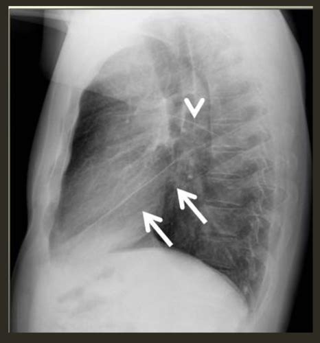 Radio Pato Pleural Flashcards Quizlet