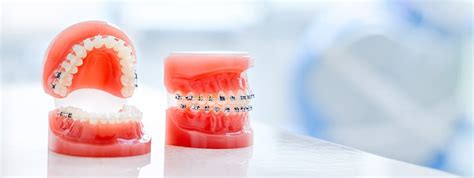 What Happens During Orthodontic Treatment Aperture Dental Practice