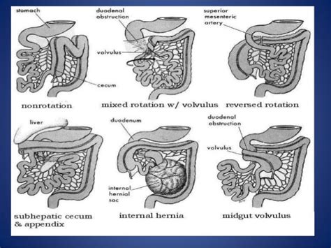 Malrotation Of Gut