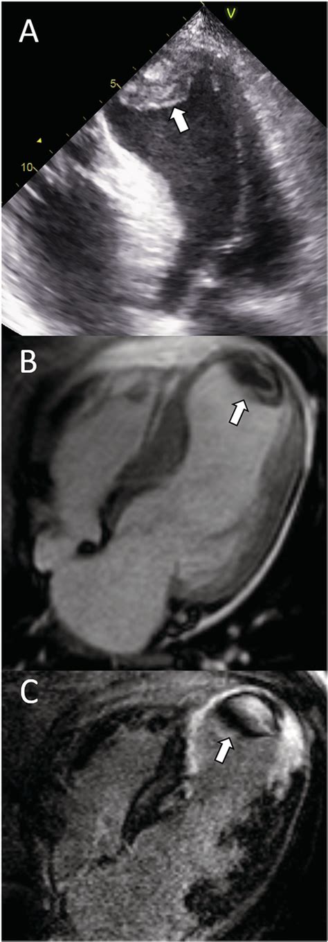 Left Ventricular Thrombus Formation Arrow In A Patient With Acute Download Scientific Diagram