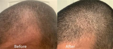 Microneedling Minoxidil For 11 Weeks Wrassman M D Baldingblog