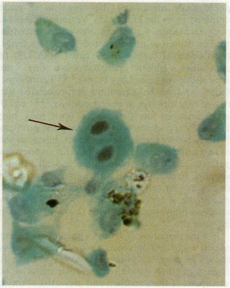 Diagnosing Pneumocystis Carinii Pneumonia By Cytological Examination Of Bronchoalveolar Lavage