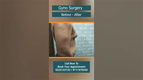 Laser Gynecomastia Surgery Shorts Viral Youtube