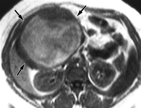 Mr Imaging Features Of Solid Pseudopapillary Tumor Of The Pancreas In