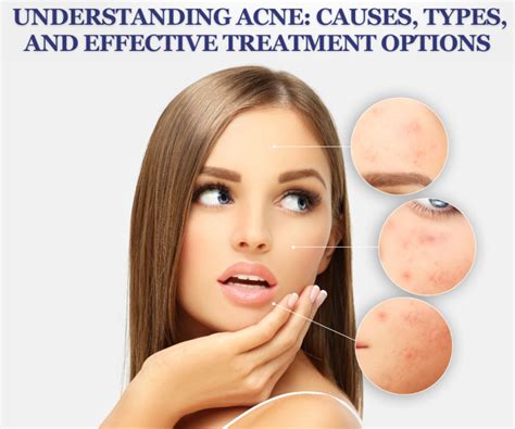 Understanding Acne Causes Types And Effective Treatment Options