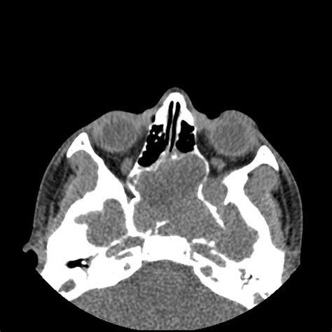 Radiology Quiz 25926 Playlist UQ Radiology Video 59 OFF