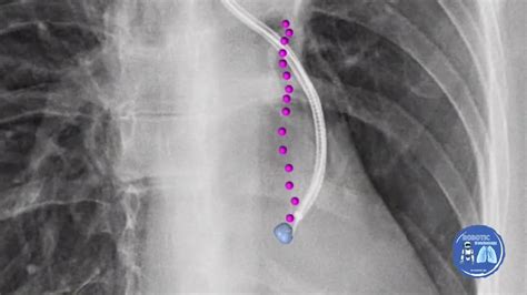 mm lung nodule biposy  robotic bronchoscopy   fluoroscopy