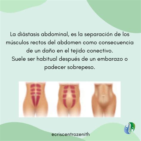 Diástasis abdominal Qué es eso Clínica Zenith