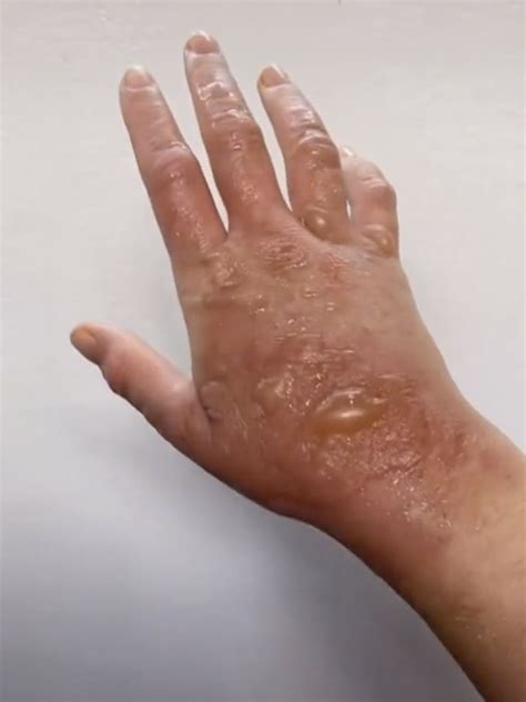 Viral Tiktok Shows Womans Margarita Dermatitis From Mexico Au — Australias Leading