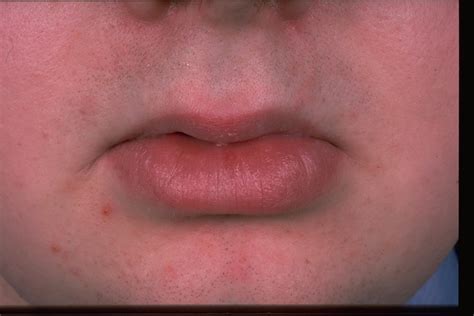 Granulomatous Cheilitis Pictures Photos