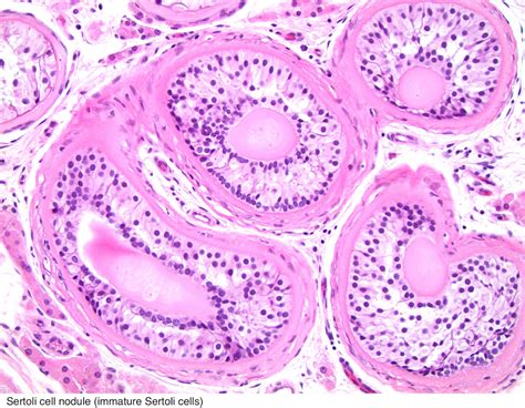 Pathology Outlines Cryptorchidism