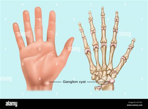 Ganglion Cyst Fluid