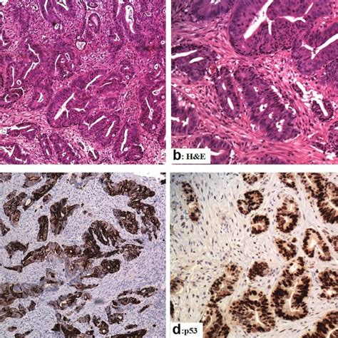 The Immunohistological Features Of The Rectal Adenocarcinoma Download Scientific Diagram