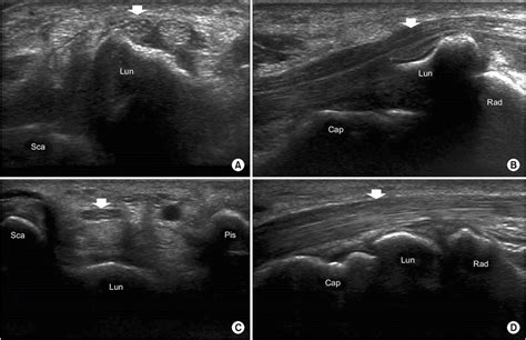 Wrist ultrasound images of the patient (A, B) and a normal subject (C ...