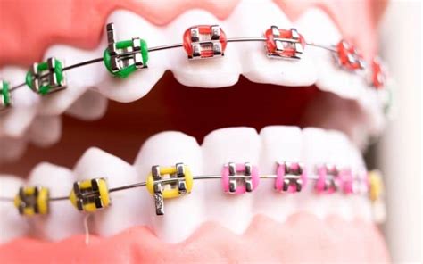 Braces Colours That You Choose Wilkinson Orthodontics Gold Coast