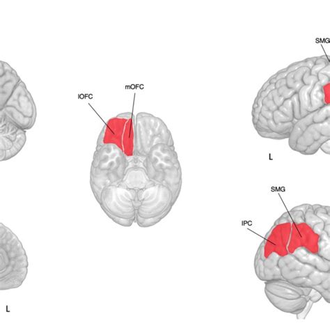 Differences In Cortical Thickness Between Subjects With Pbd And Hc