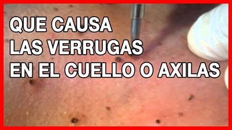 Causas De Los Acrocordones Verrugas En El Cuello O Axila Youtube