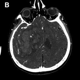 A Year Old Male Patient Presenting Within Min Of Symptom Onset