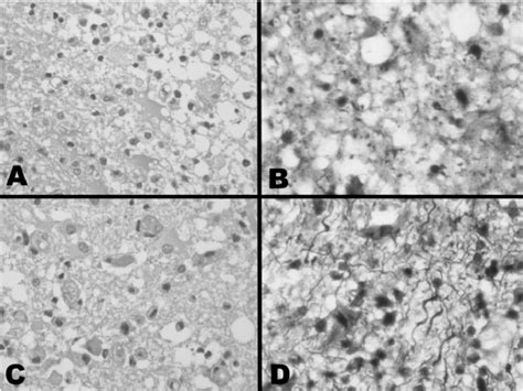 Histological features of brain parenchyma adjacent to primary CNS... | Download Scientific Diagram