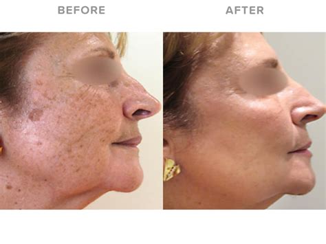 Pigmentation Removal With Candela Gentlelase Pro Eden Laser Clinics