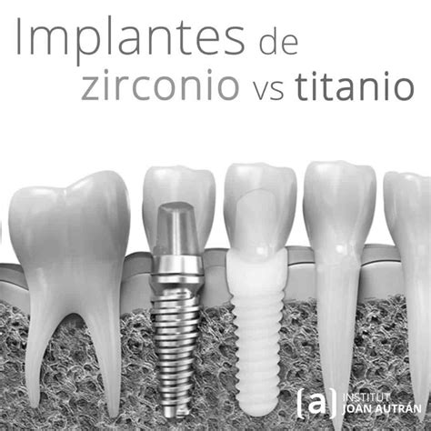 Implantes de Zirconio Qué son Materiales Imágenes etc Institut