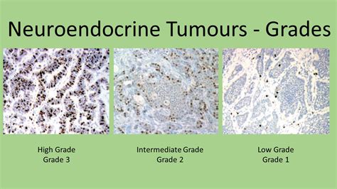 Symptoms, Diagnosis, and Treatment of Neuroendocrine Carcinomas | Dr ...