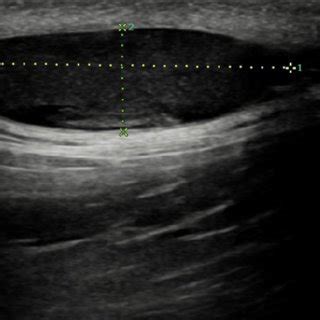 Histopathologic examination. An epidermoid cyst is lined by a squamous ...