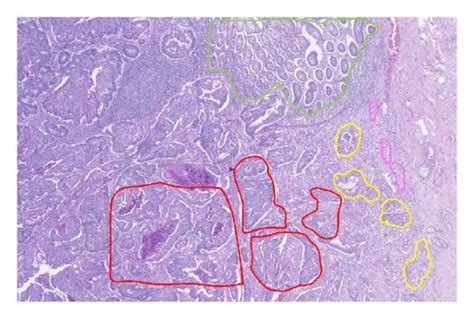 Hematoxylin And Eosin Stained Section Of A Crc Tissue With Regions