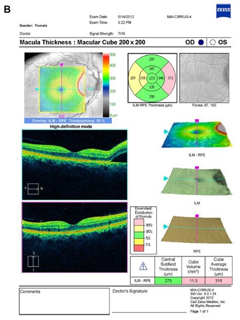 Figure 2 Oct Of The Optic Nerve And Macula B Macula Oct Demonstrates