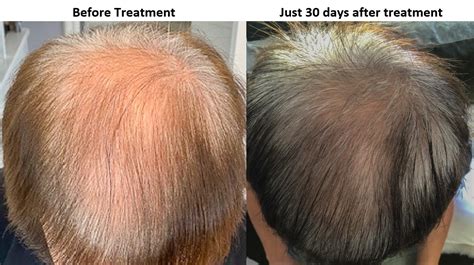 Exosome treatment for hair loss - Results at just 40 days - Alvi Armani ...