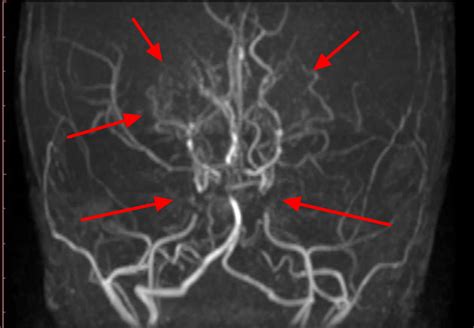 Moyamoya Disease Causes Symptoms Life Expectancy Treatment