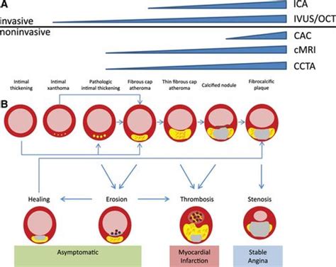 Noninvasive Imaging Of Atherosclerotic Plaque Progression Circulation