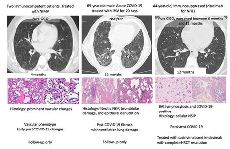 Phenotypes Of Post Covid Interstitial Lung Disease Clinical