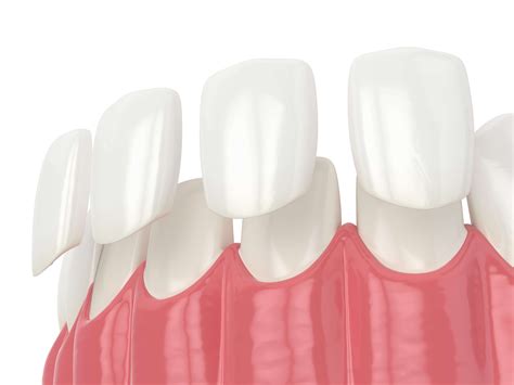 Composite Vs Porcelain Veneers Comparison Cc Dental