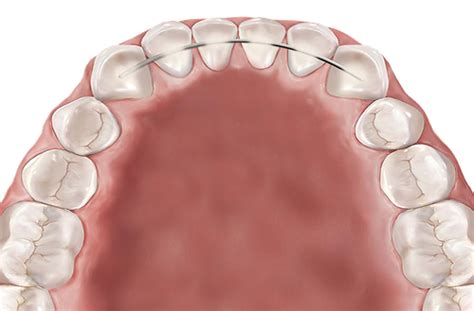 Retainers Orthodontist In Edinburgh Nhs And Clear Braces