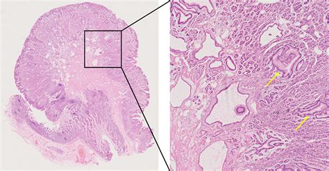 Author S Reply A True Fundic Gland Polyp In Meckel S Diverticulum