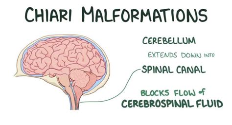 Chiari Malformation Diagnosis And Treatment