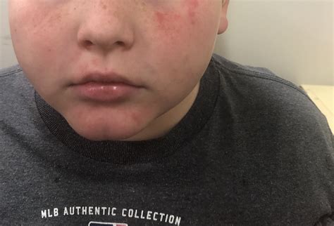 Chlorine Water Skin Rash at Marilee Smith blog