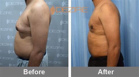 Pin On Liposuction Surgery Before After Photo Pune