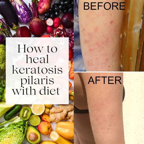 Keratosis Pilaris