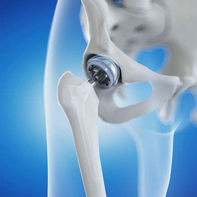 Anterior Hip Replacement - Specialty Orthopaedics, Samuel Park, MD - Orthopaedic Surgeon ...