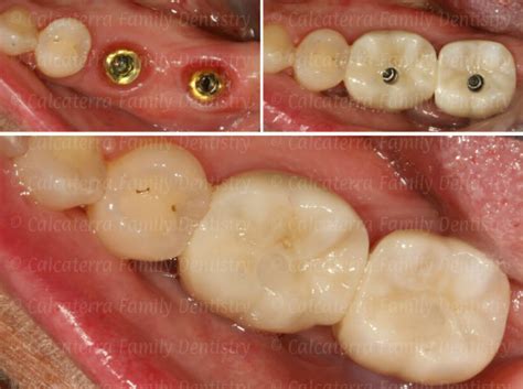 Screw Retained vs. Cemented Dental Implant Crowns