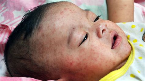 What Is Measles Symptoms Causes Diagnosis Treatment And Prevention