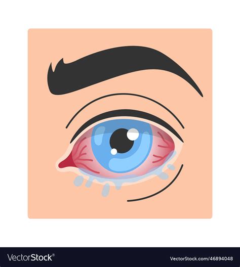 Allergic conjunctivitis eye disease Royalty Free Vector