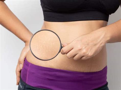 Stubborn Stretch Marks Can Also Be Cured With These Home Remedies Know