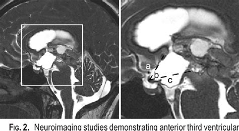 Figure 1 From Preoperative Third Ventricular Bowing As A Predictor Of Endoscopic Third